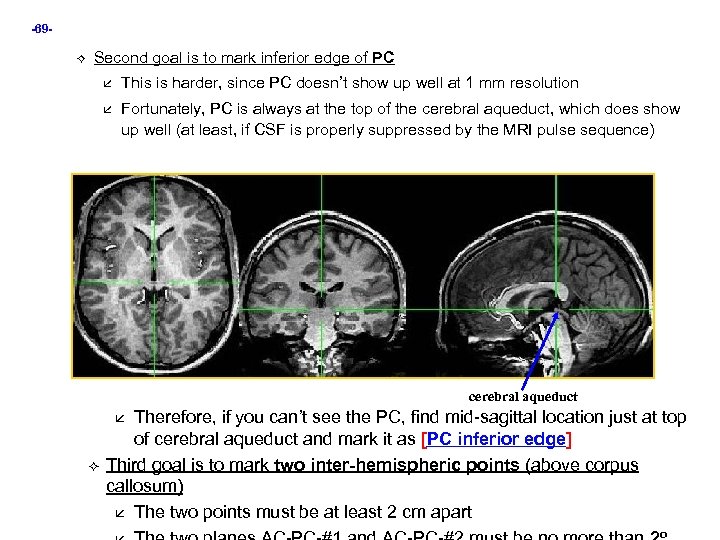 -69 Second goal is to mark inferior edge of PC This is harder, since