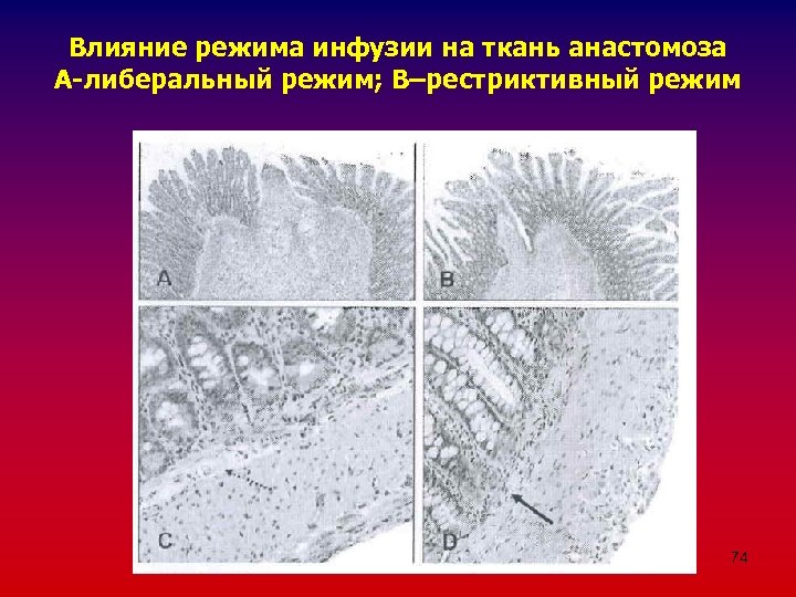 Влияние режима инфузии на ткань анастомоза А-либеральный режим; В–рестриктивный режим 74 