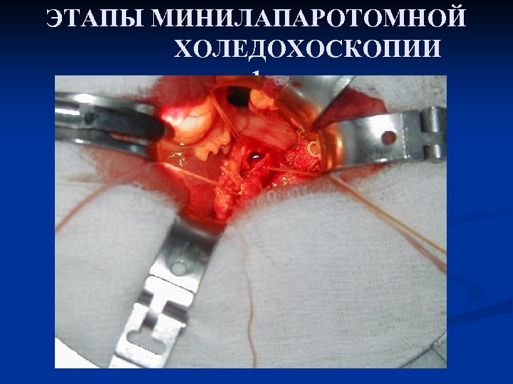ЭТАПЫ МИНИЛАПАРОТОМНОЙ ХОЛЕДОХОСКОПИИ 1 