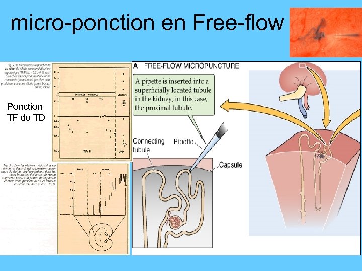 micro-ponction en Free-flow Ponction TF du TD 