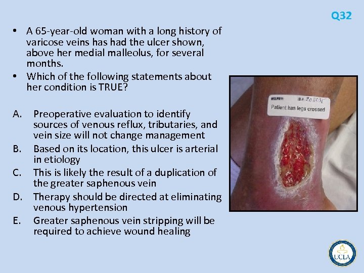 Q 32 • A 65 year old woman with a long history of varicose