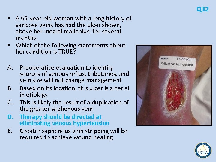 Q 32 • A 65 year old woman with a long history of varicose