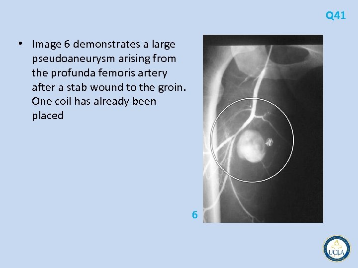 Q 41 • Image 6 demonstrates a large pseudoaneurysm arising from the profunda femoris