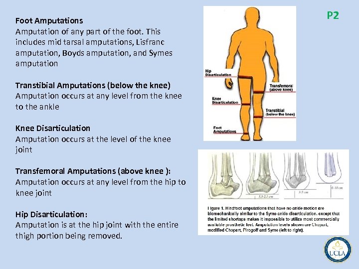 Foot Amputations Amputation of any part of the foot. This includes mid tarsal amputations,