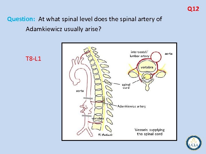 Q 12 Question: At what spinal level does the spinal artery of Adamkiewicz usually