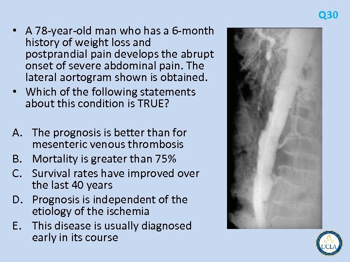 Q 30 • A 78 year old man who has a 6 month history
