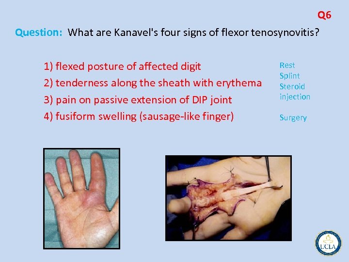 Q 6 Question: What are Kanavel's four signs of flexor tenosynovitis? Rest 1) flexed