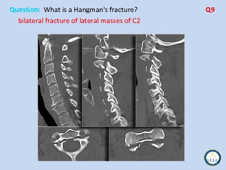 Question: What is a Hangman's fracture? bilateral fracture of lateral masses of C 2