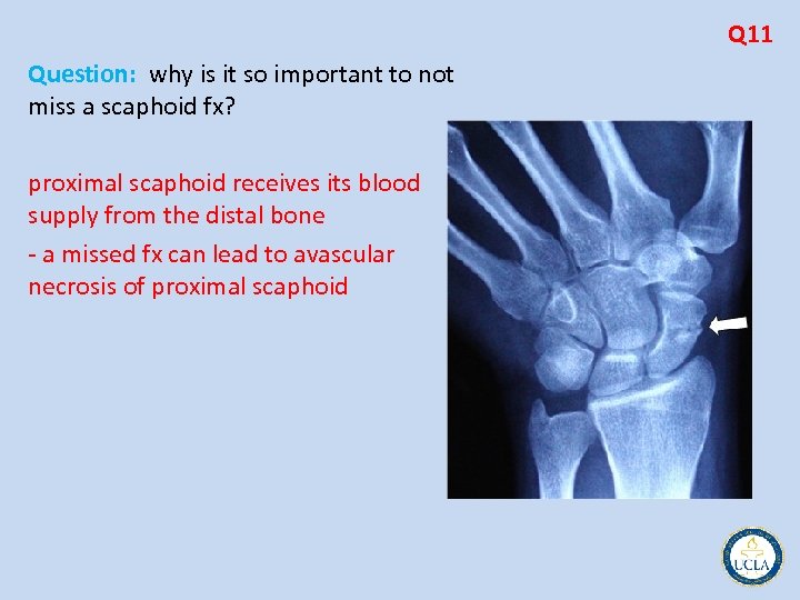 Q 11 Question: why is it so important to not miss a scaphoid fx?