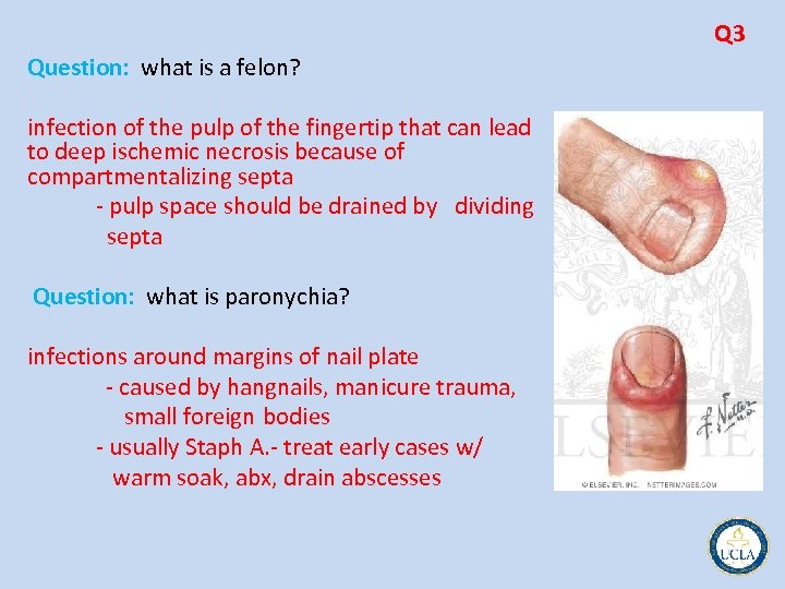 Q 3 Question: what is a felon? infection of the pulp of the fingertip