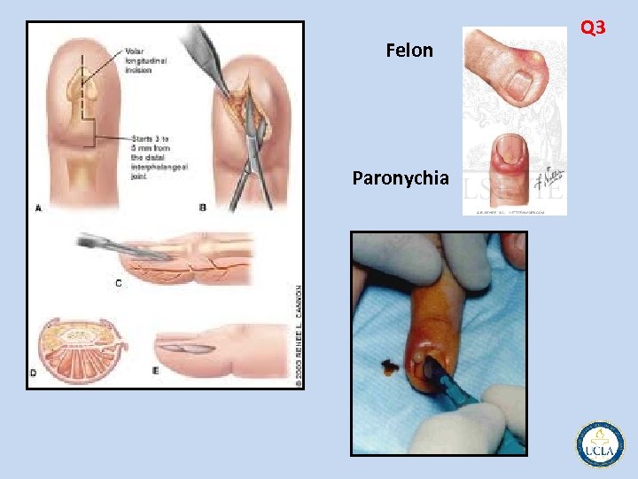 Felon Paronychia Q 3 