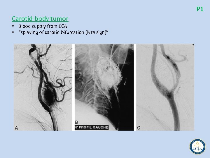 P 1 Carotid body tumor • Blood supply from ECA • “splaying of carotid