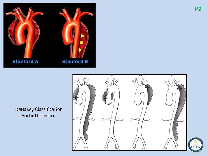 P 2 De. Bakey Classification Aortic Dissection 