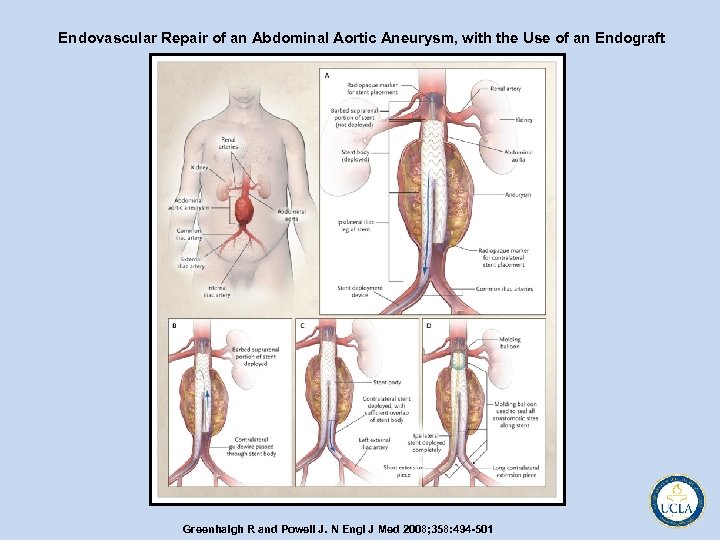 Endovascular Repair of an Abdominal Aortic Aneurysm, with the Use of an Endograft Greenhalgh
