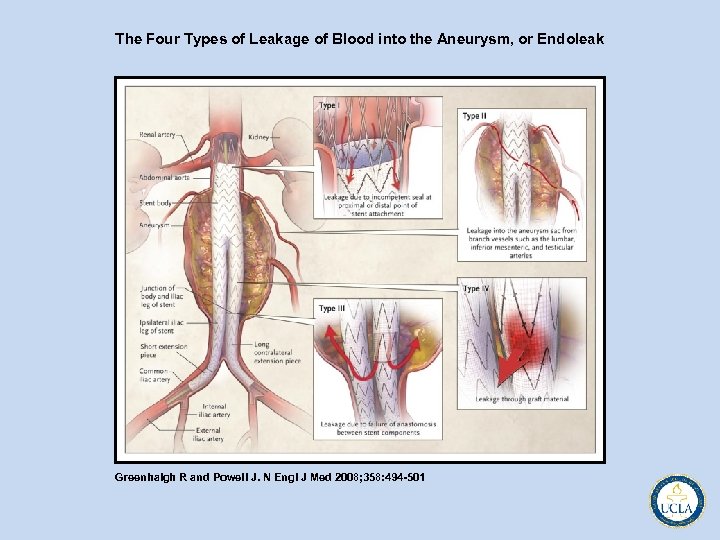 The Four Types of Leakage of Blood into the Aneurysm, or Endoleak Greenhalgh R