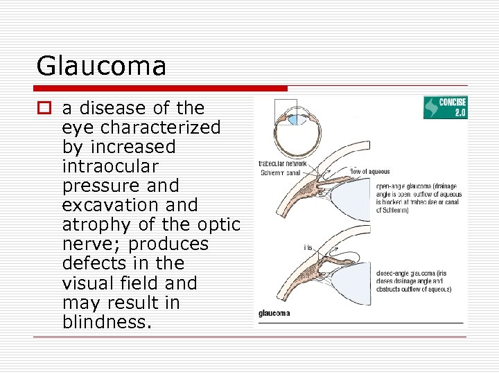 Glaucoma o a disease of the eye characterized by increased intraocular pressure and excavation