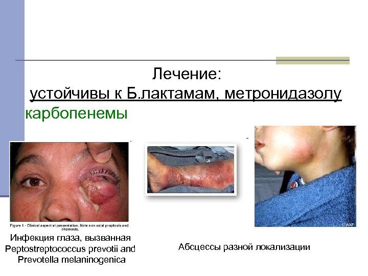 Лечение: устойчивы к Б. лактамам, метронидазолу карбопенемы Инфекция глаза, вызванная Peptostreptococcus prevotii and Prevotella