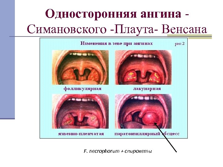 Односторонняя ангина Симановского -Плаута- Венсана F. necrophorum + спирохеты 