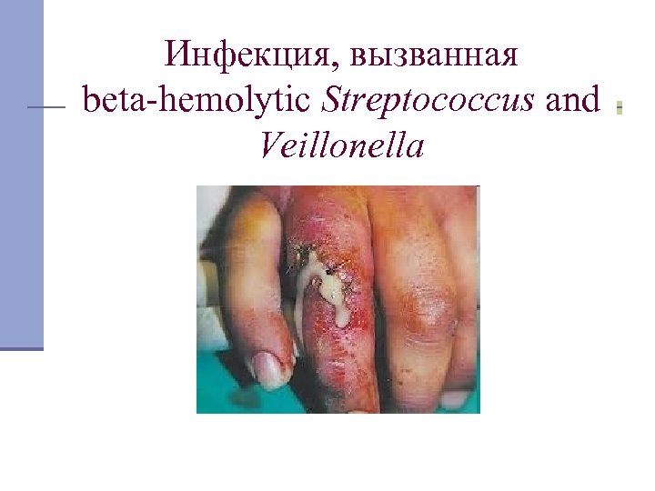 Инфекция, вызванная beta-hemolytic Streptococcus and Veillonella 