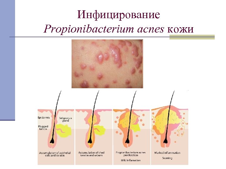 Инфицирование Propionibacterium acnes кожи 