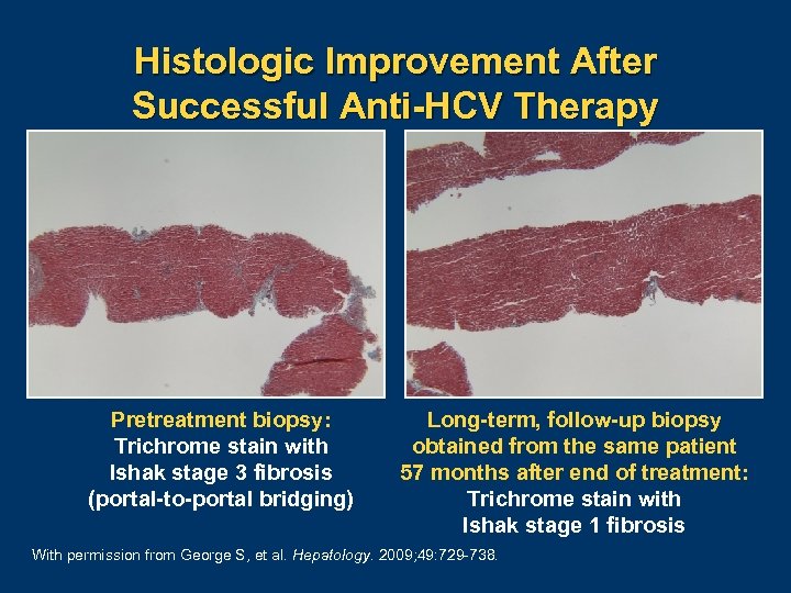 Histologic Improvement After Successful Anti-HCV Therapy Pretreatment biopsy: Trichrome stain with Ishak stage 3