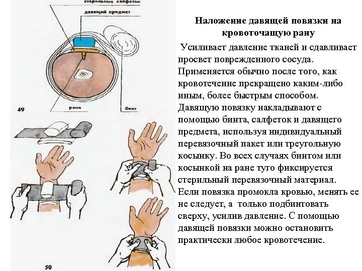 Рисунок наложение давящей повязки