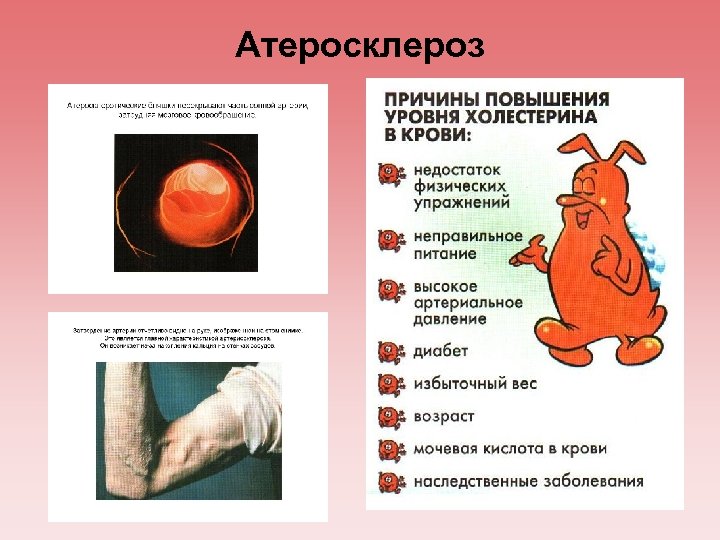 Атеросклероз 