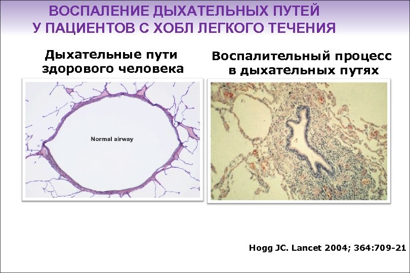ВОСПАЛЕНИЕ ДЫХАТЕЛЬНЫХ ПУТЕЙ У ПАЦИЕНТОВ С ХОБЛ ЛЕГКОГО ТЕЧЕНИЯ Дыхательные пути здорового человека Воспалительный