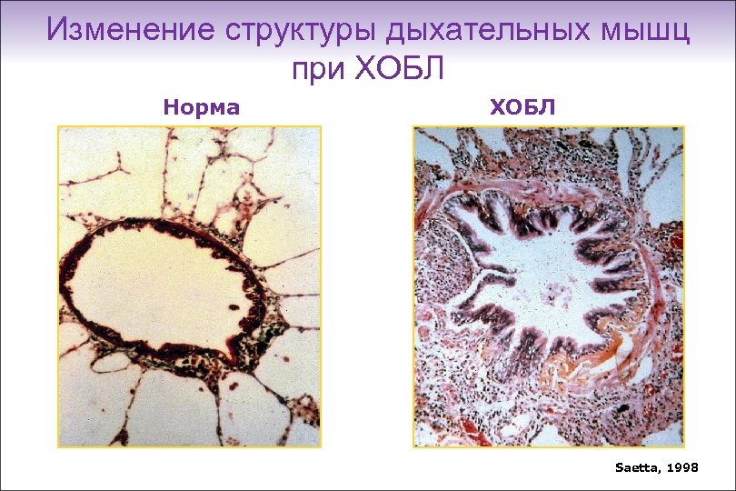 Изменение структуры дыхательных мышц при ХОБЛ Норма ХОБЛ Saetta, 1998 