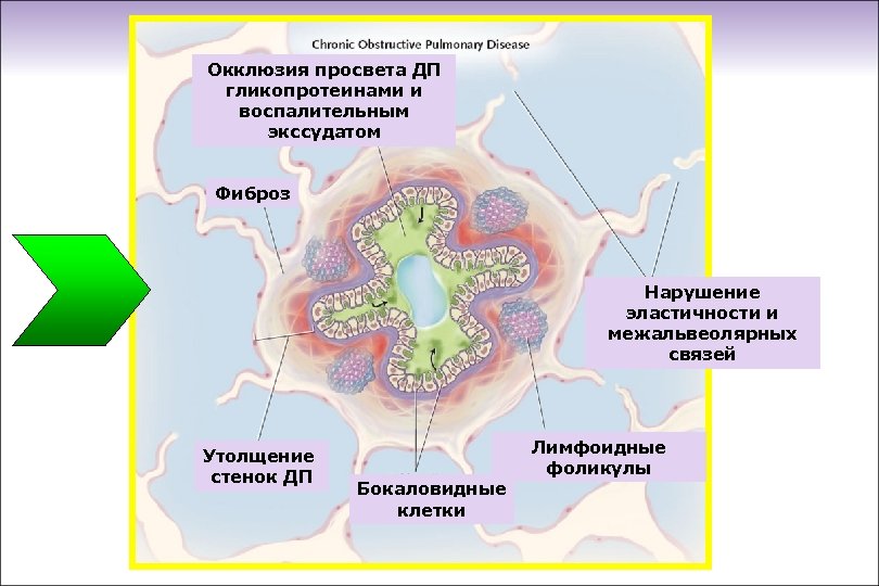 Окклюзия просвета ДП гликопротеинами и воспалительным экссудатом Фиброз Нарушение эластичности и межальвеолярных связей Утолщение