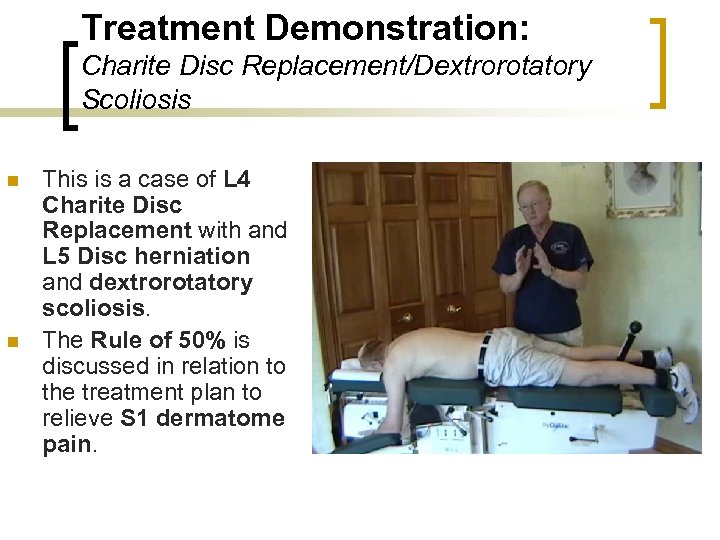 Treatment Demonstration: Charite Disc Replacement/Dextrorotatory Scoliosis n n This is a case of L