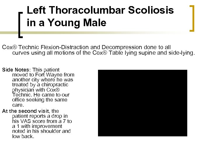 Left Thoracolumbar Scoliosis in a Young Male Cox® Technic Flexion-Distraction and Decompression done to