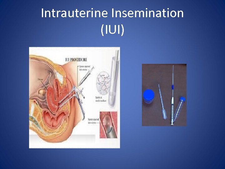 Intrauterine Insemination (IUI) 