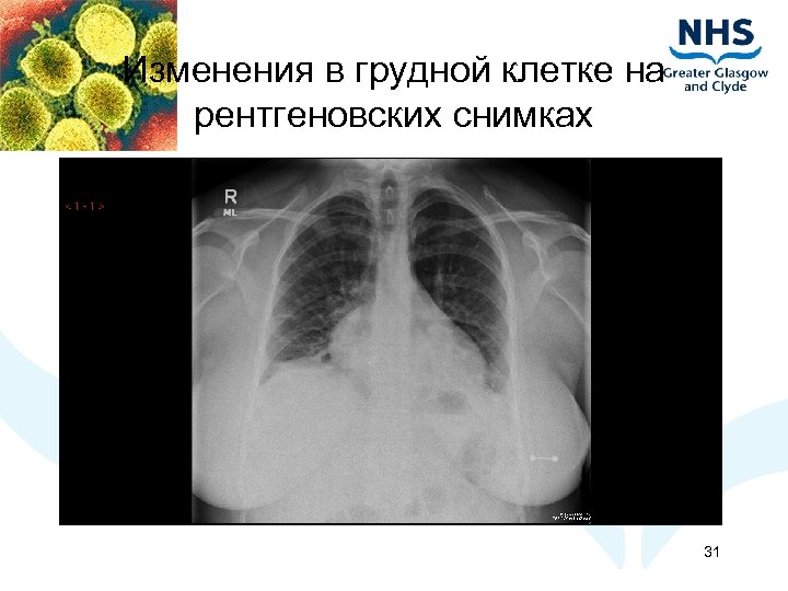 Изменения в грудной клетке на рентгеновских снимках 31 