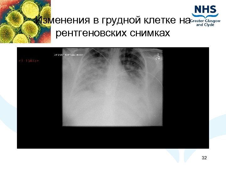 Изменения в грудной клетке на рентгеновских снимках 32 