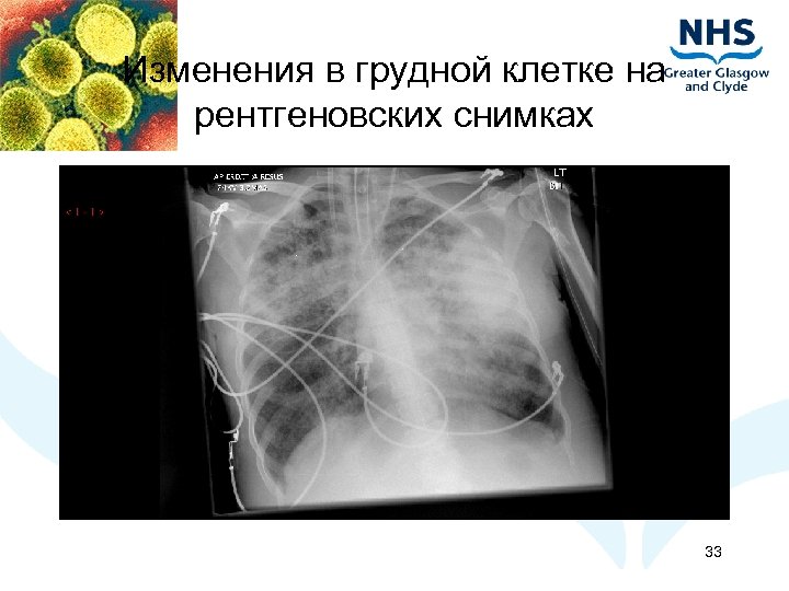 Изменения в грудной клетке на рентгеновских снимках 33 