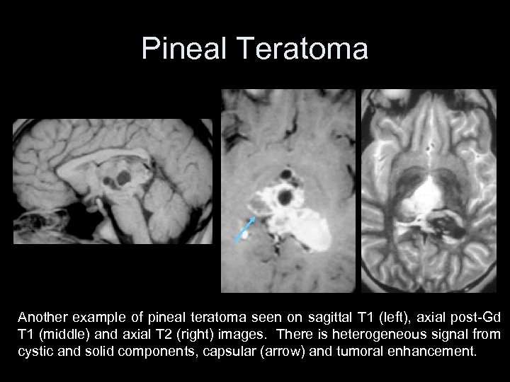 Pineal Teratoma Another example of pineal teratoma seen on sagittal T 1 (left), axial