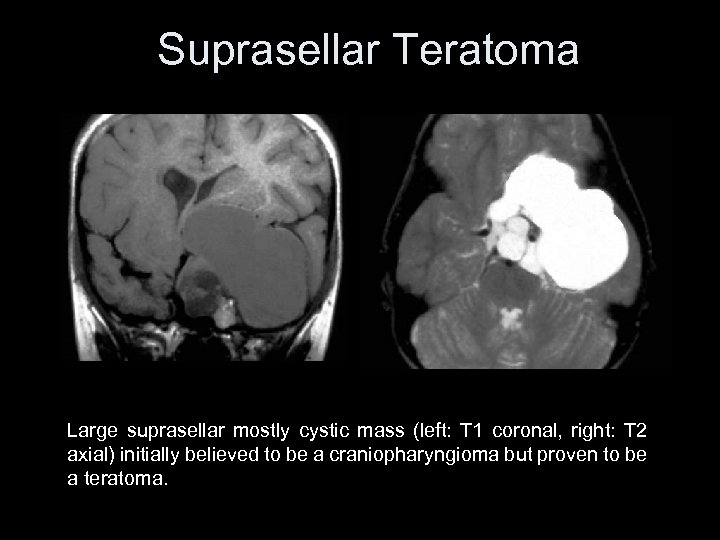 Suprasellar Teratoma Large suprasellar mostly cystic mass (left: T 1 coronal, right: T 2
