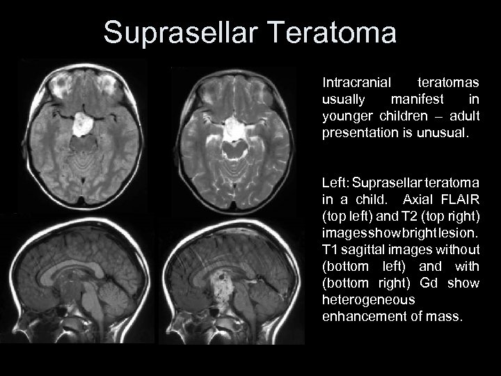 Suprasellar Teratoma Intracranial teratomas usually manifest in younger children – adult presentation is unusual.