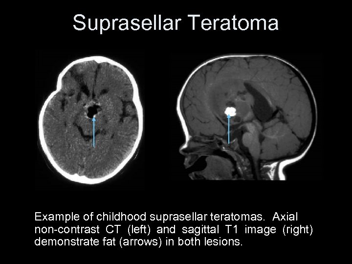 Suprasellar Teratoma Example of childhood suprasellar teratomas. Axial non-contrast CT (left) and sagittal T