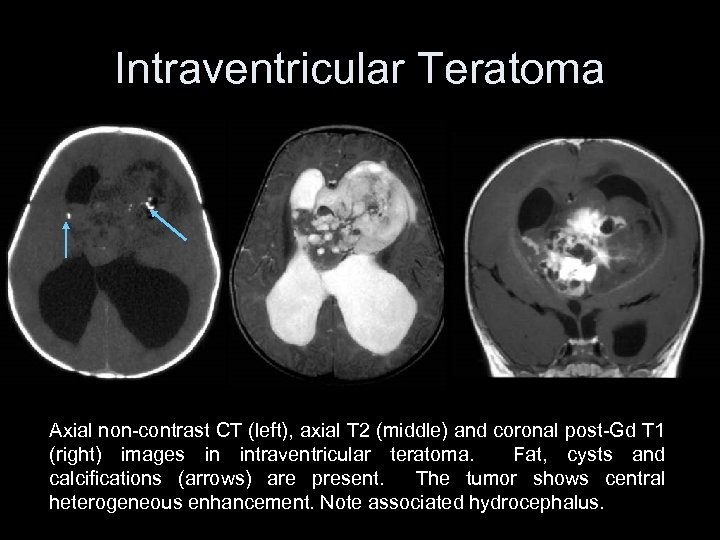 Intraventricular Teratoma Axial non-contrast CT (left), axial T 2 (middle) and coronal post-Gd T