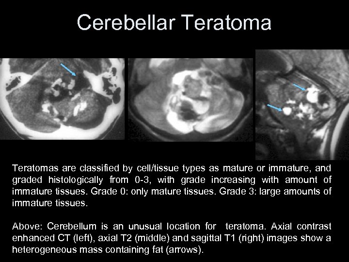 Cerebellar Teratomas are classified by cell/tissue types as mature or immature, and graded histologically