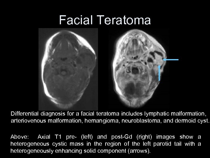 Facial Teratoma Differential diagnosis for a facial teratoma includes lymphatic malformation, arteriovenous malformation, hemangioma,