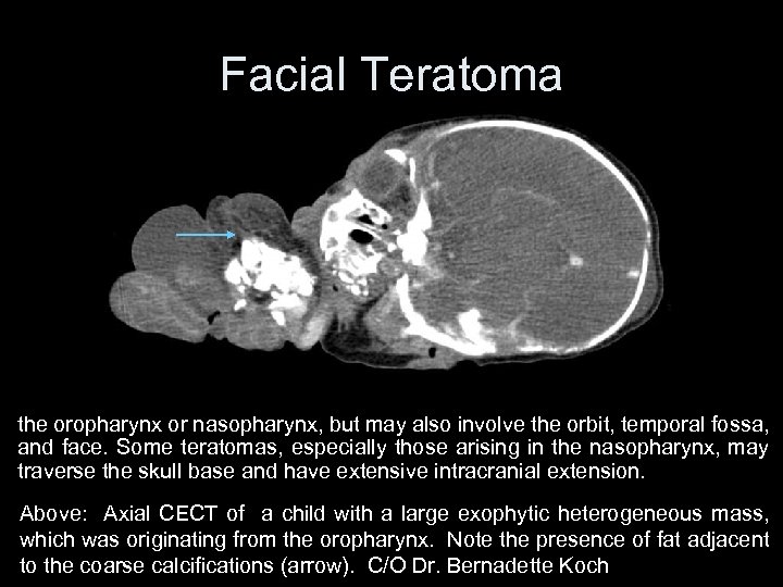 Facial Teratoma the oropharynx or nasopharynx, but may also involve the orbit, temporal fossa,
