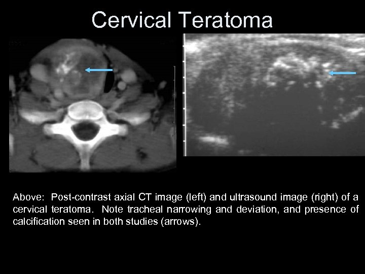 Cervical Teratoma Above: Post-contrast axial CT image (left) and ultrasound image (right) of a