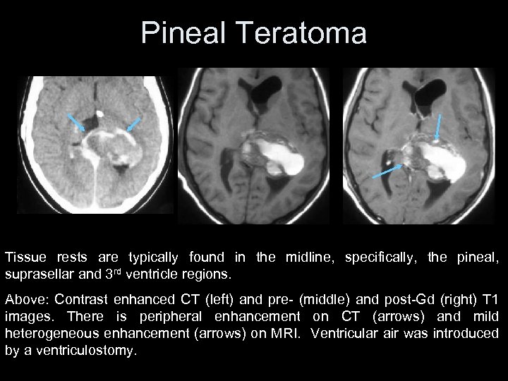 Pineal Teratoma Tissue rests are typically found in the midline, specifically, the pineal, suprasellar