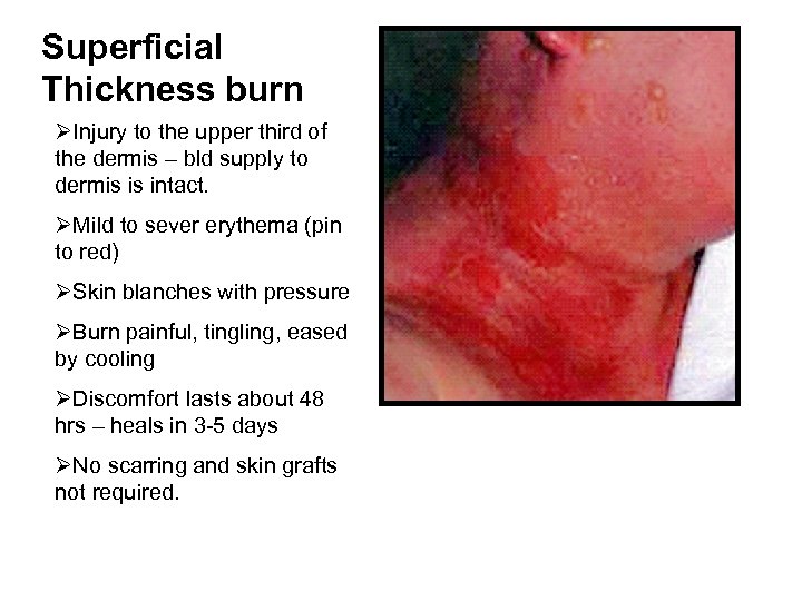 Superficial Thickness burn ØInjury to the upper third of the dermis – bld supply