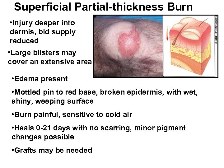Superficial Partial-thickness Burn • Injury deeper into dermis, bld supply reduced • Large blisters