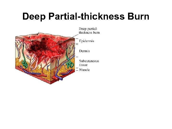 Deep Partial-thickness Burn 