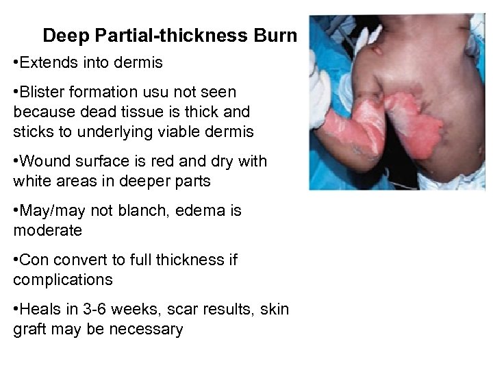 Deep Partial-thickness Burn • Extends into dermis • Blister formation usu not seen because